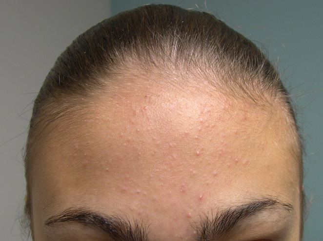 Maladie de peau : acné - Définition et Avis du Dermatologue