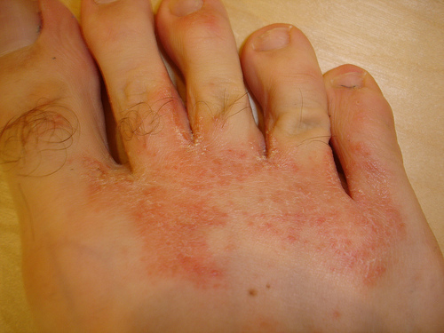 Maladie de la peau : Mycose - les conseils du dermatologue