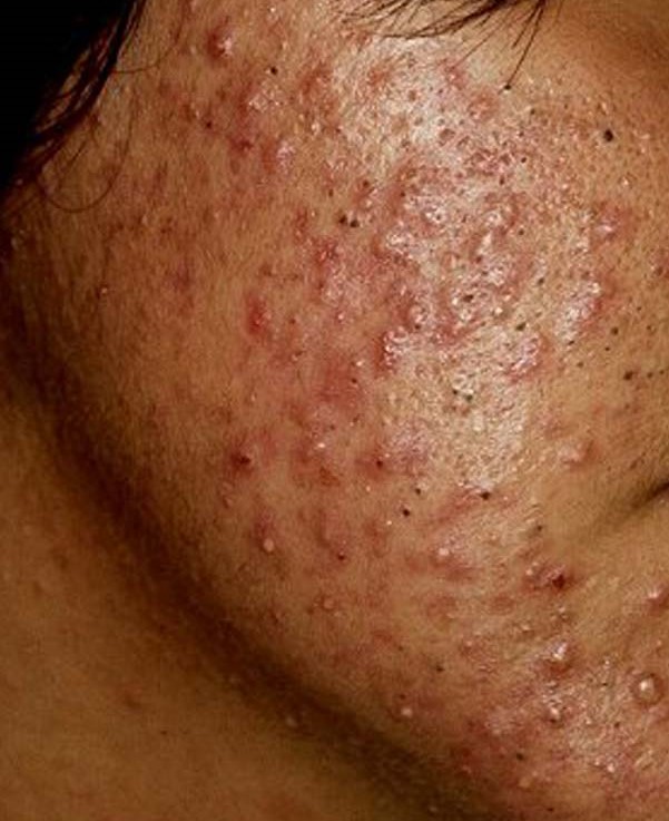 Maladie de peau : acné - Définition et Avis du Dermatologue