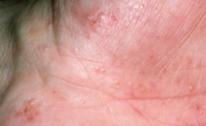 eczema-1-copie-82-300x183