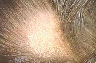 Le Dermatologue et la Chute de cheveux - Alopécie