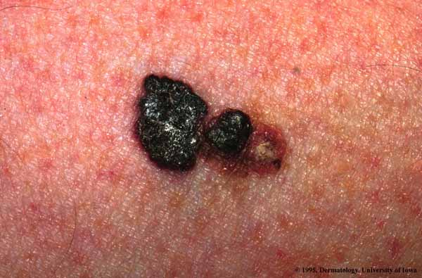 Cancer de peau : Le mélanome Dubreuilh - Définition et Traitement